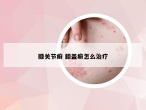 膝关节癣 膝盖癣怎么治疗