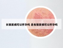 长银屑病可以怀孕吗 患有银屑病可以怀孕吗