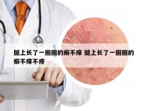 腿上长了一圈圈的癣不痒 腿上长了一圈圈的癣不痒不疼