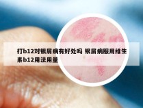 打b12对银屑病有好处吗 银屑病服用维生素b12用法用量