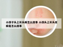 小孩子头上长头癣怎么回事 小孩头上长头皮癣是怎么回事