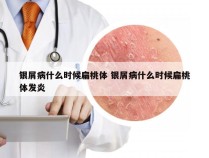 银屑病什么时候扁桃体 银屑病什么时候扁桃体发炎