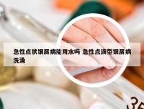 急性点状银屑病能用水吗 急性点滴型银屑病洗澡