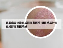 银屑病三针治愈成都哪家医院 银屑病三针治愈成都哪家医院好