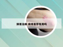 鲜姜治癣 癣用姜擦有用吗