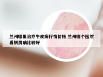 兰州哪里治疗牛皮癣行情价格 兰州哪个医院看银屑病比较好