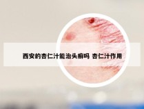 西安的杏仁汁能治头癣吗 杏仁汁作用