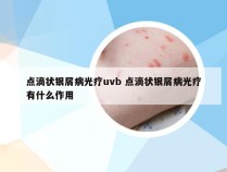 点滴状银屑病光疗uvb 点滴状银屑病光疗有什么作用