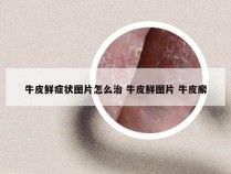 牛皮鲜症状图片怎么治 牛皮鲜图片 牛皮廨