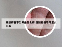 皮肤癣看不出来是什么癣 皮肤有癣不痒怎么回事