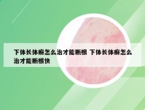 下体长体癣怎么治才能断根 下体长体癣怎么治才能断根快