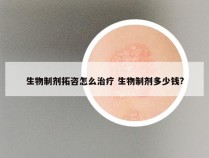 生物制剂拓咨怎么治疗 生物制剂多少钱?