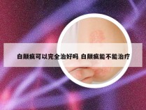 白颠疯可以完全治好吗 白颠疯能不能治疗