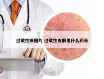 过敏性癣图片 过敏性皮癣用什么药膏