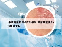 牛皮癣能用999皮炎平吗 银屑病能用999皮炎平吗