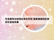 牛皮癣可以吃特比奈分片吗 银屑病用特比萘芬片后有效果