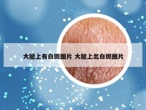 大腿上有白斑图片 大腿上出白斑图片