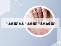 牛皮廨图片头皮 牛皮廨图片牛皮廨治疗图片