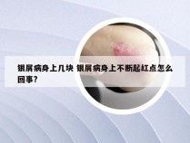 银屑病身上几块 银屑病身上不断起红点怎么回事?