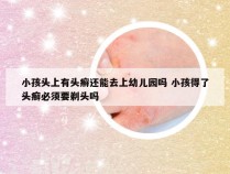 小孩头上有头癣还能去上幼儿园吗 小孩得了头癣必须要剃头吗