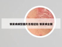 银屑病病型图片百度经验 银屑病全图