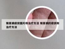 银屑病症状图片和治疗方法 银屑病的症状和治疗方法