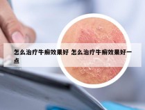 怎么治疗牛癣效果好 怎么治疗牛癣效果好一点