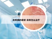 白班病的症状 白班怎么冶疗