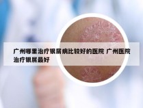 广州哪里治疗银屑病比较好的医院 广州医院治疗银屑最好