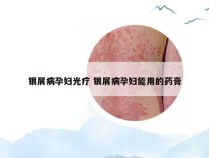 银屑病孕妇光疗 银屑病孕妇能用的药膏