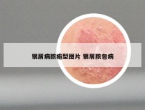 银屑病脓疱型图片 银屑脓包病