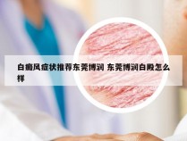 白癜风症状推荐东莞博润 东莞博润白殿怎么样