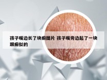 孩子嘴边长了块癣图片 孩子嘴旁边起了一块跟癣似的