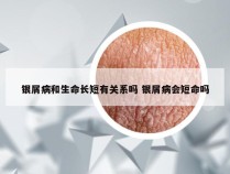 银屑病和生命长短有关系吗 银屑病会短命吗