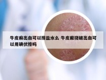 牛皮癣出血可以擦盐水么 牛皮廨挠破出血可以用碘伏擦吗