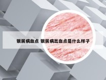 银屑病血点 银屑病出血点是什么样子