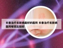 长春治疗皮肤病最好的医院 长春治疗皮肤病医院哪家比较好