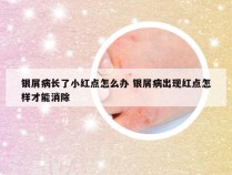 银屑病长了小红点怎么办 银屑病出现红点怎样才能消除