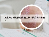 腿上长了鳞片状的癣 腿上长了鳞片状的癣图片