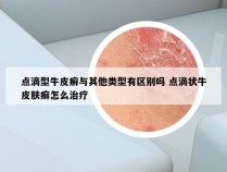 点滴型牛皮癣与其他类型有区别吗 点滴状牛皮肤癣怎么治疗