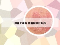 膝盖上顽癣 膝盖癣涂什么药