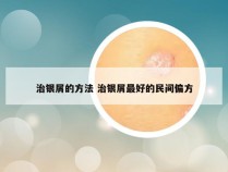 治银屑的方法 治银屑最好的民间偏方