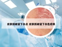 皮肤抠破留下白点 皮肤抓破留下白色疤痕