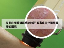 石家庄哪看银屑病比较好 石家庄治疗银屑最好的医院