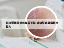 斑块型银屑病长在关节处 斑块型银屑病越来越大