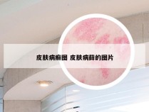 皮肤病癣图 皮肤病藓的图片