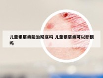 儿童银屑病能治彻底吗 儿童银屑病可以断根吗