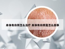 身体有白斑怎么治疗 身体有白斑是怎么回事