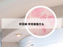 吹花癣 吹花癣是什么