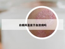 白癜风是属于血液病吗